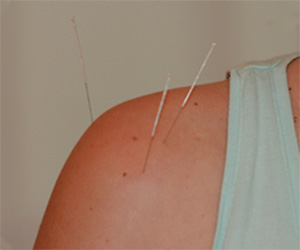 bournemouth-acupuncture